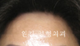 女性脱发术后