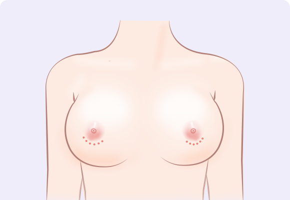 乳晕 (乳晕周围) 切开