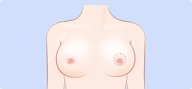乳晕切开法