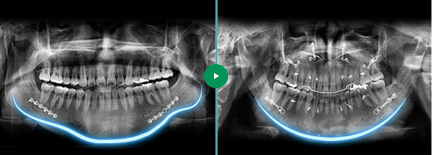 骨削手術Before & After